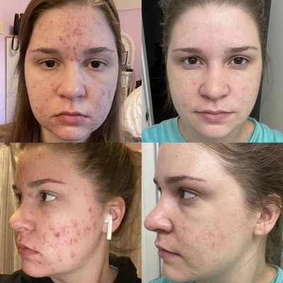 Series of Acne Treatments that Clear Skin Fast - At Esthetics by Roxanne we take clients seeking acne solutions on a journey to change their lives. Treatments are designed to enhance exfoliation, purge clogged pores, balance oil production and eliminate acne forming bacteria. A tailored at-home routine will set the standard for maintaining clear skin forever. Acne is not a disease! Series of Acne Treatments that Clear Skin Fast - At Esthetics by Roxanne we take clients seeking acne solutions on a journey to change their lives. Treatments are designed to enhance exfoliation, purge clogged pores, balance oil production and eliminate acne forming bacteria. A tailored at-home routine will set the standard for maintaining clear skin forever. Acne is not a disease!