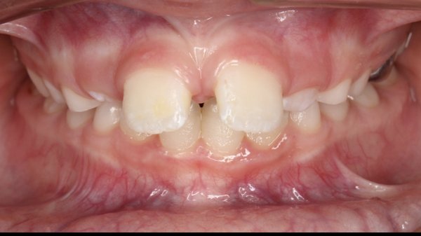 Invisalign First - Before and after using Invisalign First on a 8 year old. Invisalign First - Before and after using Invisalign First on a 8 year old.