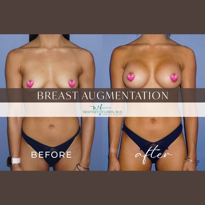 Breast Augmentation - This portfolio showcases a range of before and after results from breast augmentation procedures performed by Dr. Whitney Florin. These images highlight patient outcomes at various stages of healing, from 6 weeks to 12 months post-surgery. Breast Augmentation - This portfolio showcases a range of before and after results from breast augmentation procedures performed by Dr. Whitney Florin. These images highlight patient outcomes at various stages of healing, from 6 weeks to 12 months post-surgery.