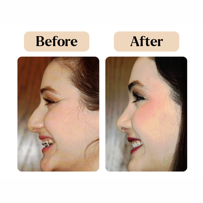 Rhinoplasty - Whether you need rhinoplasty surgery for cosmetic or medical reasons, Susan L. Chobanian, M.D.'s medical office, is here to help with exceptional and personalized customer service.
With a simple consultation, we can determine the rhinoplasty procedure that will benefit your well-being and provide you with the results you desire.
Whether your rhinoplasty surgery is for a chronic medical condition or aesthetic purposes, there are numerous benefits to receiving rhinoplasty surgery.
Through careful surgical procedures, rhinoplasty surgery can help increase or decrease the size of your nose, change the shape of your nostrils, reduce the bridge of your nose, and create a more balanced look to your facial features.
After rhinoplasty surgery, you can breathe easy again and enjoy a quiet night’s sleep.
Additionally, if you have any issues with snoring, rhinoplasty surgery can help create more open pathways in your nose.
For over 25 years, Dr. Chobanian has provided patients throughout Glendale and the surrounding areas with quality cosmetic medical procedures.
Contact us today to learn more about our services and schedule your first visit. Rhinoplasty - Whether you need rhinoplasty surgery for cosmetic or medical reasons, Susan L. Chobanian, M.D.'s medical office, is here to help with exceptional and personalized customer service.
With a simple consultation, we can determine the rhinoplasty procedure that will benefit your well-being and provide you with the results you desire.
Whether your rhinoplasty surgery is for a chronic medical condition or aesthetic purposes, there are numerous benefits to receiving rhinoplasty surgery.
Through careful surgical procedures, rhinoplasty surgery can help increase or decrease the size of your nose, change the shape of your nostrils, reduce the bridge of your nose, and create a more balanced look to your facial features.
After rhinoplasty surgery, you can breathe easy again and enjoy a quiet night’s sleep.
Additionally, if you have any issues with snoring, rhinoplasty surgery can help create more open pathways in your nose.
For over 25 years, Dr. Chobanian has provided patients throughout Glendale and the surrounding areas with quality cosmetic medical procedures.
Contact us today to learn more about our services and schedule your first visit.
