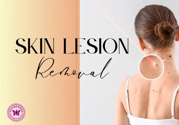 Skin Lesion Removal - Skin lesion removal is a quick and painless procedure with minimal downtime. This procedure utilizes laser technology to gently shave the lesion away (layer by layer) from the surface of the skin. Patients can return to work straight away. After the consultation, we offer same-day treatment (if desired). Pricing can vary depending on numerous factors such as how many lesions require removal, their location, and their size. Skin Lesion Removal - Skin lesion removal is a quick and painless procedure with minimal downtime. This procedure utilizes laser technology to gently shave the lesion away (layer by layer) from the surface of the skin. Patients can return to work straight away. After the consultation, we offer same-day treatment (if desired). Pricing can vary depending on numerous factors such as how many lesions require removal, their location, and their size.