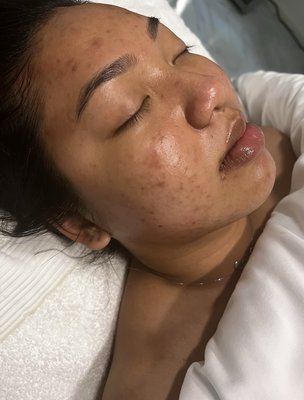 Corrective Skincare - Client started treatments 12/22/2022-current and her skin has made drastic improvements!
If you feel like your skin needs some TLC, book your consultation and lets get you closer to reaching your skincare goals! Corrective Skincare - Client started treatments 12/22/2022-current and her skin has made drastic improvements!
If you feel like your skin needs some TLC, book your consultation and lets get you closer to reaching your skincare goals!