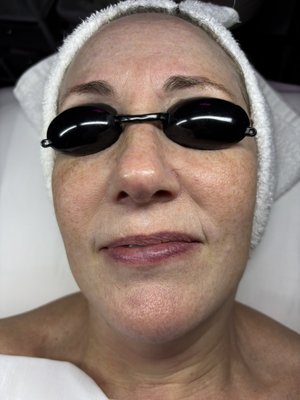Before and afters of Hydrojelly and chemical peel facials - Before and after of various facial services Before and afters of Hydrojelly and chemical peel facials - Before and after of various facial services