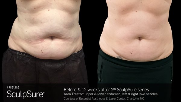 Warm Sculpting for a sleeker you. - Warm laser sculpting with Sculpsure is a way to reduce stubborn fat deposits in abdomen, arms, thighs, back and chin.  There is no downtime and unlike cool sculpting, there is no "shark bite" effect.  The edges feather in to the rest of your contour.  Call us to see if Sculpsure is right for you.