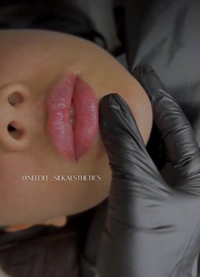 Filler - Lip enhancement performed to improve shape, symmetry, and balance while maintaining a natural appearance. Treatment was customized based on the client’s anatomy and goals. All injections were performed by a licensed registered nurse.