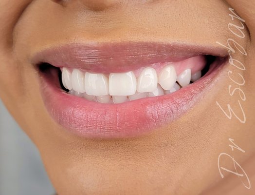 Porcelain Veneers - A set of 4 handcrafted porcelain veneers to quickly and beautiful enhance a smile. No braces or time off required.