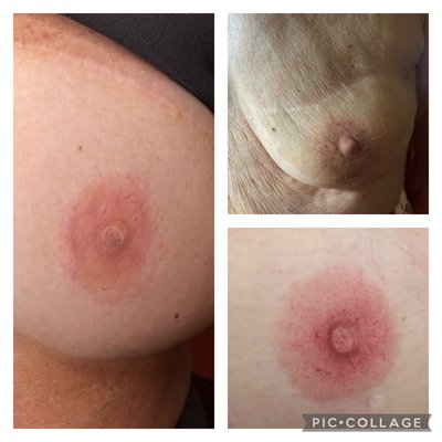 Areola micro-pigmentation - This image showcases 3D areola micropigmentation, creating the illusion of fully reconstructed nipples for women who lost them due to mastectomy. A realistic, natural look that restores confidence and wholeness. Areola micro-pigmentation - This image showcases 3D areola micropigmentation, creating the illusion of fully reconstructed nipples for women who lost them due to mastectomy. A realistic, natural look that restores confidence and wholeness.