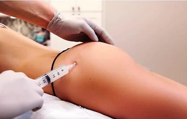 Revitalize Your Look - Hip Filler Program - Our Hip Filler Program is designed to sculpt and redefine your silhouette, offering natural-looking enhancements. Discover a confident new you with our expertly administered treatments tailored to accentuate your contours. Revitalize Your Look - Hip Filler Program - Our Hip Filler Program is designed to sculpt and redefine your silhouette, offering natural-looking enhancements. Discover a confident new you with our expertly administered treatments tailored to accentuate your contours.