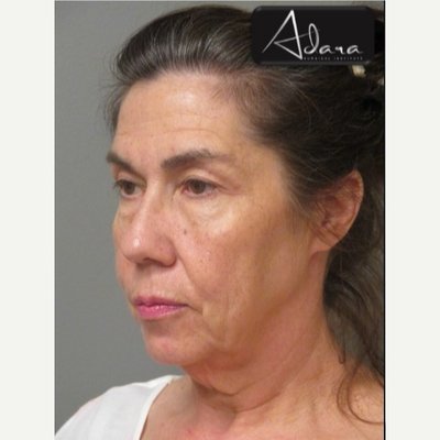 Adara Surgical Institute 55-64 year old woman Before & After treated with Facelift - Adara Surgical Institute
55-64-year-old woman Before & After Facelift Adara Surgical Institute 55-64 year old woman Before & After treated with Facelift - Adara Surgical Institute
55-64-year-old woman Before & After Facelift