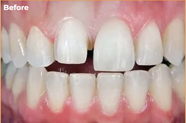 Smile Transformation with Veneers - Transform your smile with custom-crafted porcelain veneers designed to improve the appearance of stained, chipped, uneven, or worn teeth. This smile makeover showcases how veneers can create a brighter, more symmetrical, and natural-looking smile while enhancing overall facial aesthetics. Discover the benefits of cosmetic dentistry and see how veneers can deliver long-lasting, confidence-boosting results. Smile Transformation with Veneers - Transform your smile with custom-crafted porcelain veneers designed to improve the appearance of stained, chipped, uneven, or worn teeth. This smile makeover showcases how veneers can create a brighter, more symmetrical, and natural-looking smile while enhancing overall facial aesthetics. Discover the benefits of cosmetic dentistry and see how veneers can deliver long-lasting, confidence-boosting results.