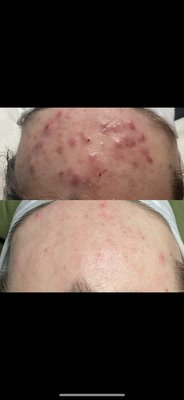 Acne treatment - 6 treatments of acne facial Acne treatment - 6 treatments of acne facial