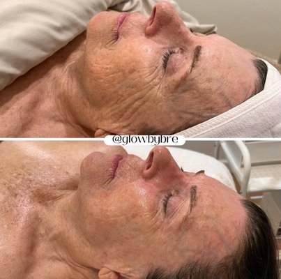 Anti-Aging Treatments - Here we did a spicule treatment, followed by a peptide treatment , focusing on anti-aging.