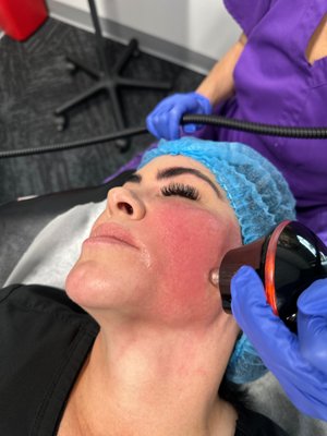 triLift - What is TriLift?
TriLift laser treatment represents a non-surgical way to refresh your face using special technology. It combines Dynamic Muscle Stimulation (DMSt™) with TriPollar RF and triFX radiofrequency microneedling. This combo helps ease facial lines, improve skin texture, and tone your muscles, giving your face a lift without surgery.
This sagging skin treatment focuses on three key aspects of aging: the look and feel of your skin, its structure, and how your face is shaped. By working on three different layers of your skin, the top layer, middle layer, and muscles, TriLift tackles all these elements.
The DMSt technology gently exercises your muscles, making them firmer and more defined. Then, the TriPollar RF and triFX microneedling steps kick in, boosting collagen and elastin in your skin. It tightens your skin, adds volume, and makes it smoother. TriLift can reduce wrinkles by about 30%, increase skin smoothness by 80%, and even triple the Hyaluronic Acid (HA) production for that youthful glow.
Is There a Downtime When Using TriLift?
TriLift doesn’t need prep or anesthesia like a surgical facelift. There’s minimal downtime, usually just 20 to 30 minutes per session. You’ll notice an immediate lift and radiance. Plus, with more sessions, your results will get even better over time.
How Does triLift Really Work?
Noninvasive energy-based treatment for the face works differently from surgery. It’s hassle-free, with minimal downtime and no need for anesthesia or special prep. Yet, it achieves facelift-like results.
TriLift simultaneously works on three aging aspects: structure, contour, and texture. It uses various technologies and energies to rejuvenate each element:
Dynamic Muscle Stimulation (DMSt) activates facial muscles, giving a toned and lifted appearance.
Third-generation TriPollar® RF thickens the dermal layer, tackling wrinkles by boosting collagen and elastin production.
TriFX RF microneedling enhances natural volume, tightens, and smoothens skin texture.
This saggy face skin treatment combines these methods to stimulate your skin’s natural rejuvenation process, providing a refreshed and lifted facial look without invasive procedures. triLift - What is TriLift?
TriLift laser treatment represents a non-surgical way to refresh your face using special technology. It combines Dynamic Muscle Stimulation (DMSt™) with TriPollar RF and triFX radiofrequency microneedling. This combo helps ease facial lines, improve skin texture, and tone your muscles, giving your face a lift without surgery.
This sagging skin treatment focuses on three key aspects of aging: the look and feel of your skin, its structure, and how your face is shaped. By working on three different layers of your skin, the top layer, middle layer, and muscles, TriLift tackles all these elements.
The DMSt technology gently exercises your muscles, making them firmer and more defined. Then, the TriPollar RF and triFX microneedling steps kick in, boosting collagen and elastin in your skin. It tightens your skin, adds volume, and makes it smoother. TriLift can reduce wrinkles by about 30%, increase skin smoothness by 80%, and even triple the Hyaluronic Acid (HA) production for that youthful glow.
Is There a Downtime When Using TriLift?
TriLift doesn’t need prep or anesthesia like a surgical facelift. There’s minimal downtime, usually just 20 to 30 minutes per session. You’ll notice an immediate lift and radiance. Plus, with more sessions, your results will get even better over time.
How Does triLift Really Work?
Noninvasive energy-based treatment for the face works differently from surgery. It’s hassle-free, with minimal downtime and no need for anesthesia or special prep. Yet, it achieves facelift-like results.
TriLift simultaneously works on three aging aspects: structure, contour, and texture. It uses various technologies and energies to rejuvenate each element:
Dynamic Muscle Stimulation (DMSt) activates facial muscles, giving a toned and lifted appearance.
Third-generation TriPollar® RF thickens the dermal layer, tackling wrinkles by boosting collagen and elastin production.
TriFX RF microneedling enhances natural volume, tightens, and smoothens skin texture.
This saggy face skin treatment combines these methods to stimulate your skin’s natural rejuvenation process, providing a refreshed and lifted facial look without invasive procedures.