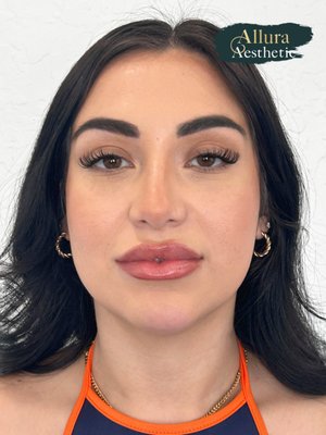 Lip Filler - The patient's goal was to have juicy lips. She got a total of 1.5cc  RHA 3 in two sessions.