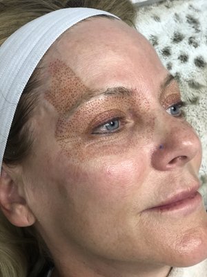 Plasma Pen - Plasma Pen is the world’s most advanced non-invasive, skin-lifting, skin-tightening, rejuvenation, resurfacing and regeneration plasma device on the market.