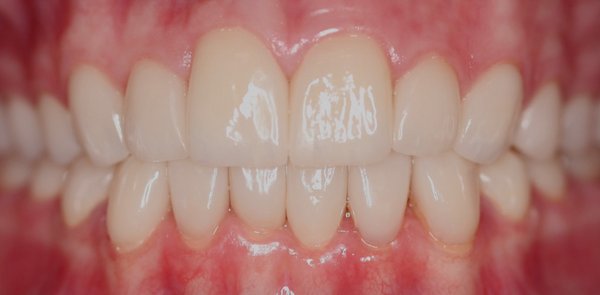 Veneers & Full Mouth Rehabilitation - This patient came to us with severe enamel erosion, discoloration, and worn-down teeth affecting both function and aesthetics. They were experiencing sensitivity and difficulty chewing — and wanted to restore their smile and confidence.
We created a custom treatment plan that included porcelain veneers and full mouth rehabilitation to rebuild proper bite alignment, restore tooth structure, and dramatically enhance the smile’s appearance.
✅ Before: Extensive enamel loss, uneven wear, and deep staining.
✅ After: A healthy, beautifully balanced smile with full function restored — and a natural, radiant look.
This comprehensive transformation combined precision dentistry with an artistic touch to deliver both comfort and confidence. Veneers & Full Mouth Rehabilitation - This patient came to us with severe enamel erosion, discoloration, and worn-down teeth affecting both function and aesthetics. They were experiencing sensitivity and difficulty chewing — and wanted to restore their smile and confidence.
We created a custom treatment plan that included porcelain veneers and full mouth rehabilitation to rebuild proper bite alignment, restore tooth structure, and dramatically enhance the smile’s appearance.
✅ Before: Extensive enamel loss, uneven wear, and deep staining.
✅ After: A healthy, beautifully balanced smile with full function restored — and a natural, radiant look.
This comprehensive transformation combined precision dentistry with an artistic touch to deliver both comfort and confidence.