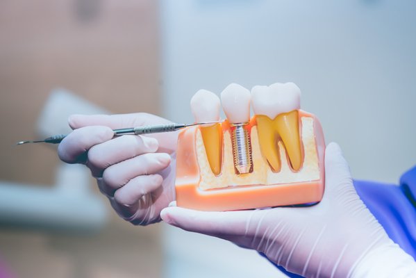 DISCOVER PREMIER DENTAL IMPLANTS - At Seattle Smiles Company, Under the experienced care of Dr. Ajay Kashi, we're dedicated to transforming smiles with the most advanced dental implant solutions available. Nestled in the heart of Downtown Seattle, our practice is a beacon of dental innovation and patient care. Surrounded by the vibrant neighborhoods of First Hill, the Central District, and Pike/Pine, and situated conveniently near Seattle University and Seattle University Park, our location is as accessible as it is picturesque!
THE BENEFITS OF CHOOSING DENTAL IMPLANTS
Dental implants are more than just a dental procedure; they're a pathway to restoring your confidence, your smile, and your health. Here are the transformative benefits they offer:
Preservation of Natural Bone: Stimulating bone growth where it matters most.
Long-Term Value: A durable, cost-effective solution for tooth replacement.
Natural Look and Feel: Designed to blend seamlessly with your natural teeth.
Permanent Solution: Say goodbye to discomfort and the hassle of temporary fixes.
EXPERT DENTAL IMPLANT SERVICES OFFERED
At Seattle Smiles Company, led by the esteemed Dr. Ajay Kashi, we're not just providing dental implants; we're offering a gateway to a renewed sense of confidence and quality of life. Understanding that each patient comes to us with unique needs, we've tailored a range of specialized dental implant services designed to cater to every individual case.
From comprehensive Full Mouth Implants for those seeking a complete oral transformation to the precision of All on X and All on 4 Implants for targeted restoration, our clinic stands at the forefront of dental implant technology and technique.
Our Dental Implant Restorations go beyond mere functionality; they are meticulously crafted to harmonize with your natural facial structure, offering an aesthetic that feels and looks natural. Dr. Kashi takes pride in utilizing only the highest quality materials, ensuring that each implant not only fits perfectly but also provides the strength and durability expected of natural teeth.
Whether you are looking to replace a single tooth or seeking a full mouth restoration, our team is committed to delivering results that exceed your expectations, ensuring that your smile is as vibrant as your spirit. DISCOVER PREMIER DENTAL IMPLANTS - At Seattle Smiles Company, Under the experienced care of Dr. Ajay Kashi, we're dedicated to transforming smiles with the most advanced dental implant solutions available. Nestled in the heart of Downtown Seattle, our practice is a beacon of dental innovation and patient care. Surrounded by the vibrant neighborhoods of First Hill, the Central District, and Pike/Pine, and situated conveniently near Seattle University and Seattle University Park, our location is as accessible as it is picturesque!
THE BENEFITS OF CHOOSING DENTAL IMPLANTS
Dental implants are more than just a dental procedure; they're a pathway to restoring your confidence, your smile, and your health. Here are the transformative benefits they offer:
Preservation of Natural Bone: Stimulating bone growth where it matters most.
Long-Term Value: A durable, cost-effective solution for tooth replacement.
Natural Look and Feel: Designed to blend seamlessly with your natural teeth.
Permanent Solution: Say goodbye to discomfort and the hassle of temporary fixes.
EXPERT DENTAL IMPLANT SERVICES OFFERED
At Seattle Smiles Company, led by the esteemed Dr. Ajay Kashi, we're not just providing dental implants; we're offering a gateway to a renewed sense of confidence and quality of life. Understanding that each patient comes to us with unique needs, we've tailored a range of specialized dental implant services designed to cater to every individual case.
From comprehensive Full Mouth Implants for those seeking a complete oral transformation to the precision of All on X and All on 4 Implants for targeted restoration, our clinic stands at the forefront of dental implant technology and technique.
Our Dental Implant Restorations go beyond mere functionality; they are meticulously crafted to harmonize with your natural facial structure, offering an aesthetic that feels and looks natural. Dr. Kashi takes pride in utilizing only the highest quality materials, ensuring that each implant not only fits perfectly but also provides the strength and durability expected of natural teeth.
Whether you are looking to replace a single tooth or seeking a full mouth restoration, our team is committed to delivering results that exceed your expectations, ensuring that your smile is as vibrant as your spirit.