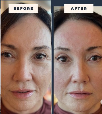 EMFace - lift and tone your face without downtime or needles! Build muscles to lift your lower face, jawline, cheeks and brow! - EMFace is a revolutionary device that does what no other device can do - lift and build muscles of the face for a more define jawline and chin area, lifted brows for rejuvenating eye area and cheeks back where they belong - higher on our cheekbones where they once were.
The quality and texture of skin is enchanced and looks smoother and more plumped.
Get a facelift with no needles or downtime or for after a facelift to optimize results!
Great instead of Botox and fillers or you can use less! EMFace - lift and tone your face without downtime or needles! Build muscles to lift your lower face, jawline, cheeks and brow! - EMFace is a revolutionary device that does what no other device can do - lift and build muscles of the face for a more define jawline and chin area, lifted brows for rejuvenating eye area and cheeks back where they belong - higher on our cheekbones where they once were.
The quality and texture of skin is enchanced and looks smoother and more plumped.
Get a facelift with no needles or downtime or for after a facelift to optimize results!
Great instead of Botox and fillers or you can use less!