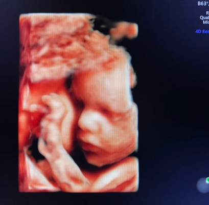 Best imaging and ultrasound experience - We have the latest in ultrasound imaging technology to give you the best Ultrasounds. Gender Determination Starts at 14 Weeks with 100% accuracy. You can come in as early as 6 weeks to confirm your pregnancy and anytime to check on the health of your baby. Baby in Blossom offers an intimate experience utilizing technology to capture precious moments and foster a deeper connection between families and their unborn babies. Best imaging and ultrasound experience - We have the latest in ultrasound imaging technology to give you the best Ultrasounds. Gender Determination Starts at 14 Weeks with 100% accuracy. You can come in as early as 6 weeks to confirm your pregnancy and anytime to check on the health of your baby. Baby in Blossom offers an intimate experience utilizing technology to capture precious moments and foster a deeper connection between families and their unborn babies.