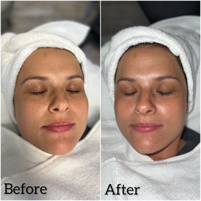 Hydrafacial Treatment - Let your skin feel refreshed