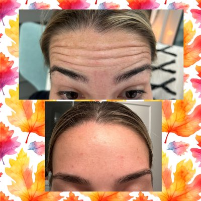 Botox by Love Your Look by Tara - Botox has been used for decades to help soften the appearance of facial lines and wrinkles, allowing you to look and feel your best. At Love Your Look by Tara, I offer Botox treatments that have been proven to be safe, effective solutions with long-lasting results. As a result, you can eliminate the appearance of wrinkles without impacting the ability to make natural expressions. In addition, As your experienced aesthetician, I can provide you with a personalized quote based on your needs and desired outcome. Love Your Look by Tara also offers cheek fillers designed to enhance facial contours and create a youthful, lifted appearance. Contact me for more information about Botox services. Botox by Love Your Look by Tara - Botox has been used for decades to help soften the appearance of facial lines and wrinkles, allowing you to look and feel your best. At Love Your Look by Tara, I offer Botox treatments that have been proven to be safe, effective solutions with long-lasting results. As a result, you can eliminate the appearance of wrinkles without impacting the ability to make natural expressions. In addition, As your experienced aesthetician, I can provide you with a personalized quote based on your needs and desired outcome. Love Your Look by Tara also offers cheek fillers designed to enhance facial contours and create a youthful, lifted appearance. Contact me for more information about Botox services.