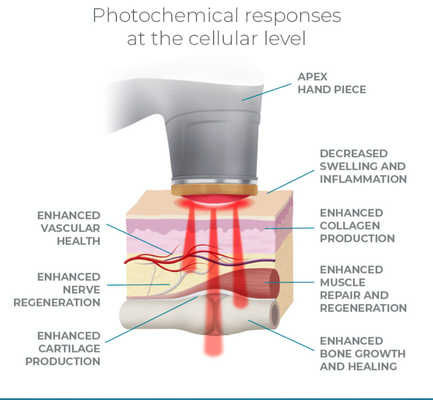 Photobiomodulation Explained - Aspen Laser Therapy (also known as photobiomodulation therapy or “PBMT”) generates photochemical responses at the cellular level which increase circulation and cellular energy production while reducing inflammation and oxidative stress. PBMT also increases the rate and quality of tissue repair, improves muscle performance, enhances recovery and alleviates pain. Visit website for more information.