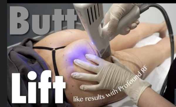 Profound RF Skin Tightening - Profound RF Skin Tightening in Scottsdale
Non-Surgical Treatment for Loose Skin After Weight Loss Medications (Ozempic® & Zepbound®)
Weight loss with GLP-1 medications such as Ozempic® and Zepbound® can transform your health, but many patients notice an unwanted side effect—loose or sagging skin. This is especially common in the lower face, jawline, neck, arms, and abdomen after rapid weight reduction.
At Sensational Skin in Scottsdale, under the expert direction of Dr. S. Kent Brown, we offer Profound RF®, a cutting-edge radiofrequency microneedling treatment that tightens and firms skin without surgery.
Why Skin Can Look Loose After Weight Loss
When weight is lost quickly, the skin doesn’t always have time to contract and adapt to the new shape of your body. This can lead to:
Sagging along the jawline or “Ozempic® face”
Lax skin on the neck or under the chin
Wrinkling or crepey skin on the arms, abdomen, or thighs
This happens because the collagen and elastin fibers in the skin lose their strength with age, volume change, or rapid fat loss.
How Profound RF Works
Profound RF combines microneedling with radiofrequency energy to stimulate the skin’s natural healing response. By precisely heating the deeper dermal layers, Profound RF triggers the production of:
New collagen for firmness
Elastin for skin elasticity
Hyaluronic acid for natural hydration
The result: tighter, smoother, and more youthful-looking skin that continues to improve for months after treatment.
Benefits of Profound RF
Non-surgical, no incisions
Safe for multiple skin types and tones
Can treat face, neck, arms, abdomen, thighs, and more
Long-lasting collagen stimulation
Minimal downtime compared to surgery Profound RF Skin Tightening - Profound RF Skin Tightening in Scottsdale
Non-Surgical Treatment for Loose Skin After Weight Loss Medications (Ozempic® & Zepbound®)
Weight loss with GLP-1 medications such as Ozempic® and Zepbound® can transform your health, but many patients notice an unwanted side effect—loose or sagging skin. This is especially common in the lower face, jawline, neck, arms, and abdomen after rapid weight reduction.
At Sensational Skin in Scottsdale, under the expert direction of Dr. S. Kent Brown, we offer Profound RF®, a cutting-edge radiofrequency microneedling treatment that tightens and firms skin without surgery.
Why Skin Can Look Loose After Weight Loss
When weight is lost quickly, the skin doesn’t always have time to contract and adapt to the new shape of your body. This can lead to:
Sagging along the jawline or “Ozempic® face”
Lax skin on the neck or under the chin
Wrinkling or crepey skin on the arms, abdomen, or thighs
This happens because the collagen and elastin fibers in the skin lose their strength with age, volume change, or rapid fat loss.
How Profound RF Works
Profound RF combines microneedling with radiofrequency energy to stimulate the skin’s natural healing response. By precisely heating the deeper dermal layers, Profound RF triggers the production of:
New collagen for firmness
Elastin for skin elasticity
Hyaluronic acid for natural hydration
The result: tighter, smoother, and more youthful-looking skin that continues to improve for months after treatment.
Benefits of Profound RF
Non-surgical, no incisions
Safe for multiple skin types and tones
Can treat face, neck, arms, abdomen, thighs, and more
Long-lasting collagen stimulation
Minimal downtime compared to surgery