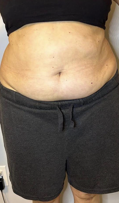 Schedule your Fat Blasting Today - Fat Blasting Schedule your Fat Blasting Today - Fat Blasting