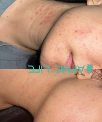 Acne Treatment - Acne treatment involves targeted therapies to clear breakouts, reduce inflammation, and prevent scarring for smoother skin. Acne Treatment - Acne treatment involves targeted therapies to clear breakouts, reduce inflammation, and prevent scarring for smoother skin.