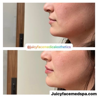Lip Filler - Am I a Good Candidate for Lip Filler?  
If you’re wondering if you’re a suitable candidate for lip fillers, we can help you find out. Lip fillers are a versatile solution for plumper and more defined lips. Whether you have naturally thin lips or have experienced volume loss over time, lip fillers will help you achieve your desired look. Ideal candidates for lip filler treatment are people who:  
👄Seek balance and symmetry: Lip fillers result in a more balanced and symmetrical appearance by addressing asymmetries or irregularities in lip shape.  
👄Desire fuller lips: If you’ve always wanted to enhance the shape and volume of your lips, lip fillers can help you achieve a plumper pout.  
👄Want a youthful look: Lip fillers provide a more youthful appearance by restoring lost volume and reducing the visibility of fine lines around the lips.