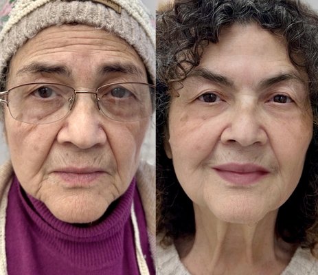 Timeless Lift: PDO Threading Transformation - Discover the transformative effects of PDO threading at VitaGlow-MD, a premier solution for non-surgical face lift and rejuvenation. PDO (polydioxanone) thread lifting is a minimally invasive technique that offers clients an effective way to achieve a face lift effect without surgery. By placing dissolvable threads under the skin, this treatment provides an instant lift, enhances facial contours, and promotes natural collagen production for long-lasting firmness.
Our thread lifting service is ideal for face rejuvenation, addressing concerns such as sagging skin, jowls, and drooping cheeks. PDO threading works by subtly lifting the skin, helping to restore youthful volume and definition, especially around the jawline, cheeks, and neck. This treatment is perfect for those looking to refresh their appearance without the extended recovery time or risks associated with surgical facelifts.
Under the skilled care of Dr. Foroozan Famoori, a double board-certified physician with over 26 years of experience, each PDO threading procedure is personalized to meet individual aesthetic goals, ensuring natural and refined results. Whether you’re looking to lift and tighten or rejuvenate the skin’s texture, PDO threading at VitaGlow-MD can help you achieve a youthful, revitalized look that feels both natural and beautiful. Schedule a consultation to explore how our advanced thread lifting can redefine your facial contours and rejuvenate your skin. Timeless Lift: PDO Threading Transformation - Discover the transformative effects of PDO threading at VitaGlow-MD, a premier solution for non-surgical face lift and rejuvenation. PDO (polydioxanone) thread lifting is a minimally invasive technique that offers clients an effective way to achieve a face lift effect without surgery. By placing dissolvable threads under the skin, this treatment provides an instant lift, enhances facial contours, and promotes natural collagen production for long-lasting firmness.
Our thread lifting service is ideal for face rejuvenation, addressing concerns such as sagging skin, jowls, and drooping cheeks. PDO threading works by subtly lifting the skin, helping to restore youthful volume and definition, especially around the jawline, cheeks, and neck. This treatment is perfect for those looking to refresh their appearance without the extended recovery time or risks associated with surgical facelifts.
Under the skilled care of Dr. Foroozan Famoori, a double board-certified physician with over 26 years of experience, each PDO threading procedure is personalized to meet individual aesthetic goals, ensuring natural and refined results. Whether you’re looking to lift and tighten or rejuvenate the skin’s texture, PDO threading at VitaGlow-MD can help you achieve a youthful, revitalized look that feels both natural and beautiful. Schedule a consultation to explore how our advanced thread lifting can redefine your facial contours and rejuvenate your skin.