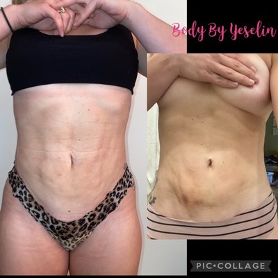 Fibrosis treatment - Fibrosis is where scar tissue forms, leading to lumpiness or hardness under the skin. 
treatment include manual massage etc.