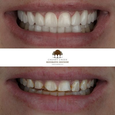 Crowns/Veneers - There are many ways our doctors can create a smile transformation in our practice. A few options consist of crowns and veneers. Crowns and veneers are always custommade and unique to fit your facial structure, mouth, and smile. Personalized every time.