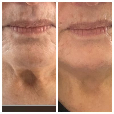 Lower face contouring, neck skin tightening using radiofrequency. - Lower face and neck skin tightening after 4 treatments Lower face contouring, neck skin tightening using radiofrequency. - Lower face and neck skin tightening after 4 treatments