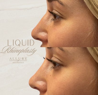 Non-Surgical Nose - Our Non-Surgical Rhinoplasty offers precise, non-invasive contouring to enhance your natural profile. Using advanced dermal fillers, this treatment subtly refines and balances the nose, delivering elegant, harmonious results without surgery. Achieve a beautifully sculpted, confident look with minimal downtime. Non-Surgical Nose - Our Non-Surgical Rhinoplasty offers precise, non-invasive contouring to enhance your natural profile. Using advanced dermal fillers, this treatment subtly refines and balances the nose, delivering elegant, harmonious results without surgery. Achieve a beautifully sculpted, confident look with minimal downtime.