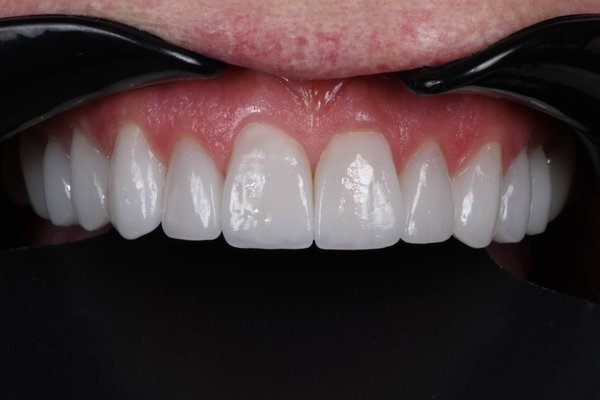 Invisalign Paired With Veneers in Newport Beach, CA - This patient was looking for a smile enhancement with cosmetic dentistry in Newport Beach, CA. Our cosmetic dentist at Spath Dentistry used a combination of cosmetic dentistry procedures like veneers and Invisalign in Newport Beach, CA to enhance this smile!