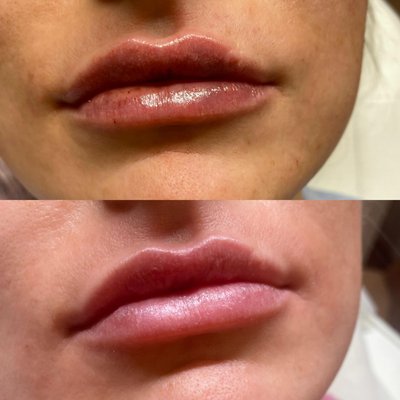 Fillers - Restylane filler to augment lips/cheeks/chin/marionette lines. Dermal Filler can also be injected into the top of the hand to fill in the area between the visible tendons and muscle loss due to aging. Fillers - Restylane filler to augment lips/cheeks/chin/marionette lines. Dermal Filler can also be injected into the top of the hand to fill in the area between the visible tendons and muscle loss due to aging.
