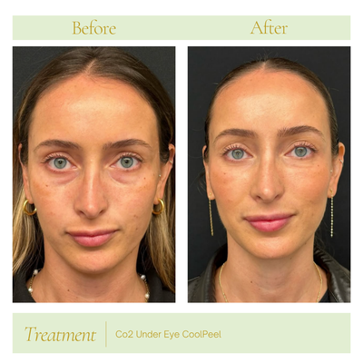 Under Eye Dark Circles - October Offer 💚

Kinda chic to do something about those under-eyes. 👀✨

Your next self-care appointment has entered the chat. 💚

Meet CO₂ CoolPeel under-eye treatment at NeuVitality:
• $339 for the under-eye treatment