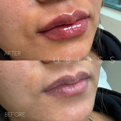 Lip Fillers - Before and After Lip Fillers
By Stella Nam, RN, BSN, AAOPM-Certified
Founder & Lead Provider
Ubliss Medical Aesthetics
🏆 National Recommended Provider – The Best Aesthetic Injectors in America
🏆 2023 & 2024 & 2025 Best in Business Medical Spa – BNS News
🏆 2024 Trust Award Winner – Winner Magazine, BNS News
🔹 AAOPM Board-Certified in Aesthetic & Functional Medicine
🔹 Featured in Top 10 Aesthetic Injectors You Need to Know – Fab World Today
📺 Featured on The Donna Drake Show | CBS Lip Fillers - Before and After Lip Fillers
By Stella Nam, RN, BSN, AAOPM-Certified
Founder & Lead Provider
Ubliss Medical Aesthetics
🏆 National Recommended Provider – The Best Aesthetic Injectors in America
🏆 2023 & 2024 & 2025 Best in Business Medical Spa – BNS News
🏆 2024 Trust Award Winner – Winner Magazine, BNS News
🔹 AAOPM Board-Certified in Aesthetic & Functional Medicine
🔹 Featured in Top 10 Aesthetic Injectors You Need to Know – Fab World Today
📺 Featured on The Donna Drake Show | CBS