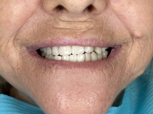 Missing Teeth: Partial Denture - This patient had been unable to see a dentist for many years because she had been focusing on raising her children. With multiple missing teeth, this patient was unable to eat well, her overall health was starting to deteriorate, and she lost her confidence to smile. After many consultations with other dental offices treatment planning a full mouth extraction and recommending implant dentures, she came to us for help. Our prosthodontist, Dr. David Choi was able to transform her, giving her the ability to chew, eat, and smile by making her a partial denture. Missing Teeth: Partial Denture - This patient had been unable to see a dentist for many years because she had been focusing on raising her children. With multiple missing teeth, this patient was unable to eat well, her overall health was starting to deteriorate, and she lost her confidence to smile. After many consultations with other dental offices treatment planning a full mouth extraction and recommending implant dentures, she came to us for help. Our prosthodontist, Dr. David Choi was able to transform her, giving her the ability to chew, eat, and smile by making her a partial denture.