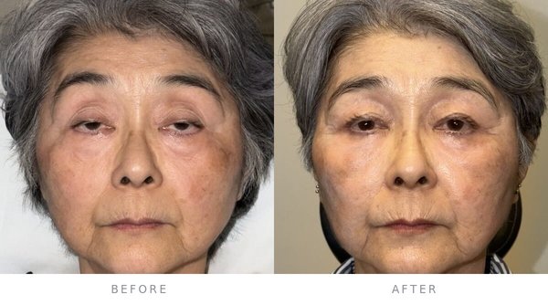 Upper Eyelid Surgery: Blepharoplasty & Ptosis Repair - The upper eyelid is where "tired" shows first: extra skin folding toward the lashes, or a lid that sits too low (ptosis). Upper blepharoplasty removes what droops; ptosis repair re-tensions the muscle that lifts the lid. The two are often confused and sometimes combined — and telling them apart is an eye exam, not a guess. Dr. Karlin is an ABO board-certified ophthalmologist and ASOPRS-certified oculofacial plastic surgeon — an eye surgeon first, which is exactly the training this operation rewards. The goal is a clean, natural lid line and an eye that still looks like yours, only rested. All photos shown with written patient consent; the exact procedures performed are listed on each photo. More consented cases, each labeled: justinkarlin.com/results Upper Eyelid Surgery: Blepharoplasty & Ptosis Repair - The upper eyelid is where "tired" shows first: extra skin folding toward the lashes, or a lid that sits too low (ptosis). Upper blepharoplasty removes what droops; ptosis repair re-tensions the muscle that lifts the lid. The two are often confused and sometimes combined — and telling them apart is an eye exam, not a guess. Dr. Karlin is an ABO board-certified ophthalmologist and ASOPRS-certified oculofacial plastic surgeon — an eye surgeon first, which is exactly the training this operation rewards. The goal is a clean, natural lid line and an eye that still looks like yours, only rested. All photos shown with written patient consent; the exact procedures performed are listed on each photo. More consented cases, each labeled: justinkarlin.com/results