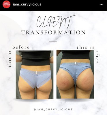 Booty Lifts - Book your non surgical booty lift / hip enhancement. Booty Lifts - Book your non surgical booty lift / hip enhancement.
