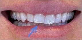 Cosmetic Dentistry - Before / After Cosmetic Dentistry - Before / After