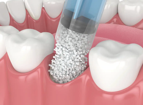 Bone Grafting - Bone Grafting
A dental bone graft is used to add volume and density to areas in your jaw where bone loss has taken place. The material for a bone graft can be your own or made from synthetic materials.

Bone grafts are used as socket preservation or ridge augmentation for future dental implants or another restorative option. They are also used to rebuild the jaw before getting dentures or because of bone loss due to periodontal disease.

The process of a bone graft procedure is first, numbing the area with a local anesthetic, then creating a small incision. The issue is moved to expose the jaw bone, then the bone graft is placed where the issue in your jawbone occurs. Lastly, the gum tissue is moved back and stitches are placed to close the incision. Once the bone graft is placed, your own bone tissue will grow and regenerate.