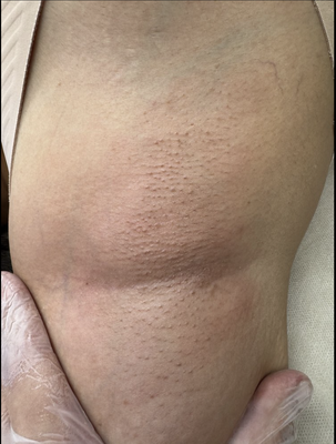 Underarm waxing - Check out our work for before and after the waxing services! Underarm waxing - Check out our work for before and after the waxing services!