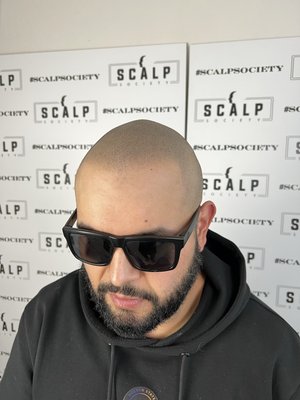 Recently finished treatments - Finished scalp micro pigmentation treatments of all various styles. Recently finished treatments - Finished scalp micro pigmentation treatments of all various styles.