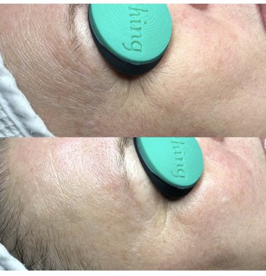 Facials Before and after - We are a different kind of face bar. We managed to squeeze a luxury spa into a boutique size and added effective devices and machine modalities to boost your skincare goals without the high price of a luxury spa. Renew & Snooze, Then Repeat. Facials Before and after - We are a different kind of face bar. We managed to squeeze a luxury spa into a boutique size and added effective devices and machine modalities to boost your skincare goals without the high price of a luxury spa. Renew & Snooze, Then Repeat.