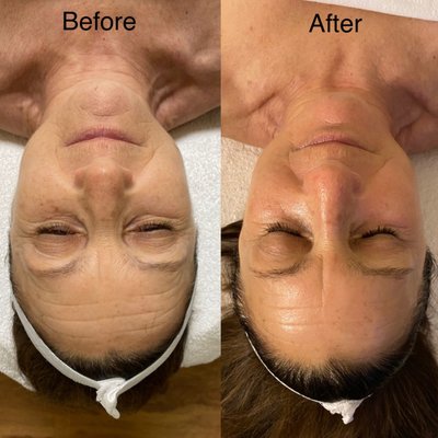 Hydrosonic Infusion Facial - “Non-invasive” doesn’t have to mean “non-effective”. A game-changer technology that allows us to push different solutions into the skin— such as retinol, vitamin cocktails, antioxidants, and CBD— up to 3 mm below the surface of the skin without using a needle.
With the innovative HydroSonic Infusion technology we are able to deliver beneficial liquid solutions through the surface of the skin to affect the deepest level of the skin.
Penetrating that outer protective layer means solutions simply work better, last longer, and have the absolute best chance of affecting change in a skin’s appearance. During the facial, we will use a powerful micro-current to tighten the skin and leave it plumped and hydrated. Hydrosonic Infusion Facial - “Non-invasive” doesn’t have to mean “non-effective”. A game-changer technology that allows us to push different solutions into the skin— such as retinol, vitamin cocktails, antioxidants, and CBD— up to 3 mm below the surface of the skin without using a needle.
With the innovative HydroSonic Infusion technology we are able to deliver beneficial liquid solutions through the surface of the skin to affect the deepest level of the skin.
Penetrating that outer protective layer means solutions simply work better, last longer, and have the absolute best chance of affecting change in a skin’s appearance. During the facial, we will use a powerful micro-current to tighten the skin and leave it plumped and hydrated.