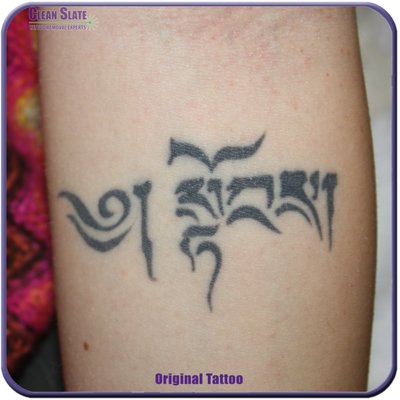Complete Removal - Dark, Saturated Black Ink - This was a dark, heavily saturated tattoo that we removed 100% in 5 sessions with no scarring or skin discoloration.