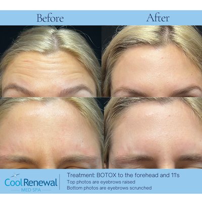 Botox - Neurotoxins refer to a class of cosmetic products that are used to temporarily reduce the appearance of wrinkles and fine lines by relaxing the muscles responsible for these facial expressions. These neurotoxins are typically injected into specific areas of the face, such as the forehead, between the eyebrows (glabellar lines), and around the eyes (crow’s feet), to create a smoother and more youthful appearance.

The most commonly used neurotoxins in the aesthetic industry are based on a purified form of botulinum toxin type A. The brand names of these products we use are BOTOX® and Dysport. While the primary use of these neurotoxins is for cosmetic purposes, they also have medical applications, such as treating conditions like muscle spasms, migraines, and excessive sweating.